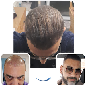saç ekimi