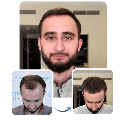 hair transplant