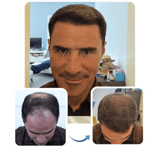 hair transplant