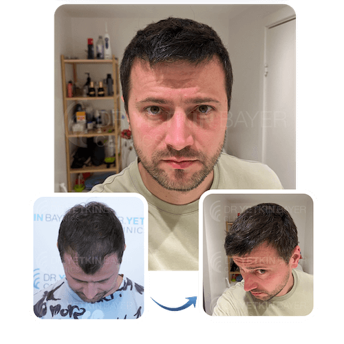 hair transplant