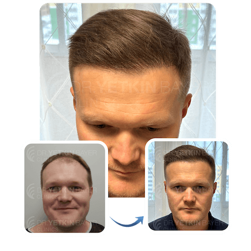 hair transplant