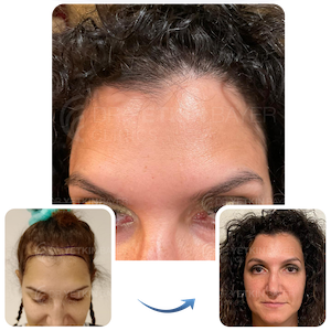 hair transplant