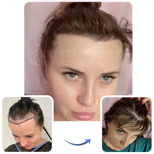 hair transplant