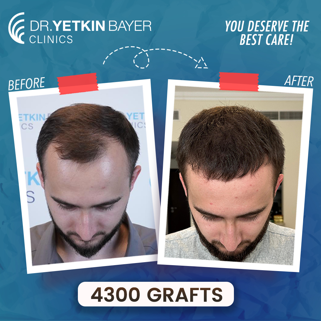 amir_safin_4300_grafts