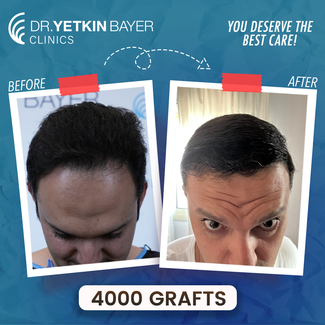 amr_mohammed_4000_grafts