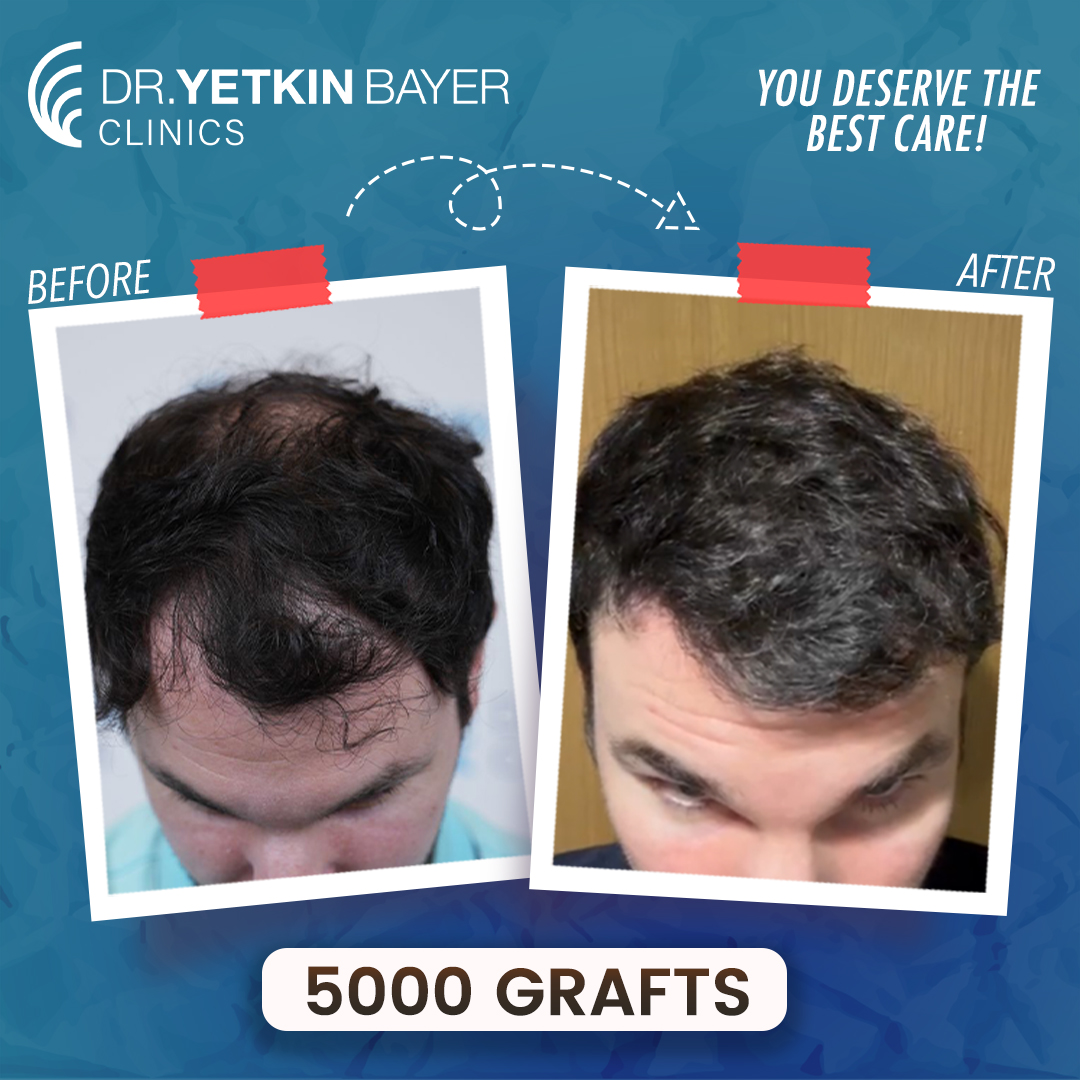 brian_murphy_5000_grafts