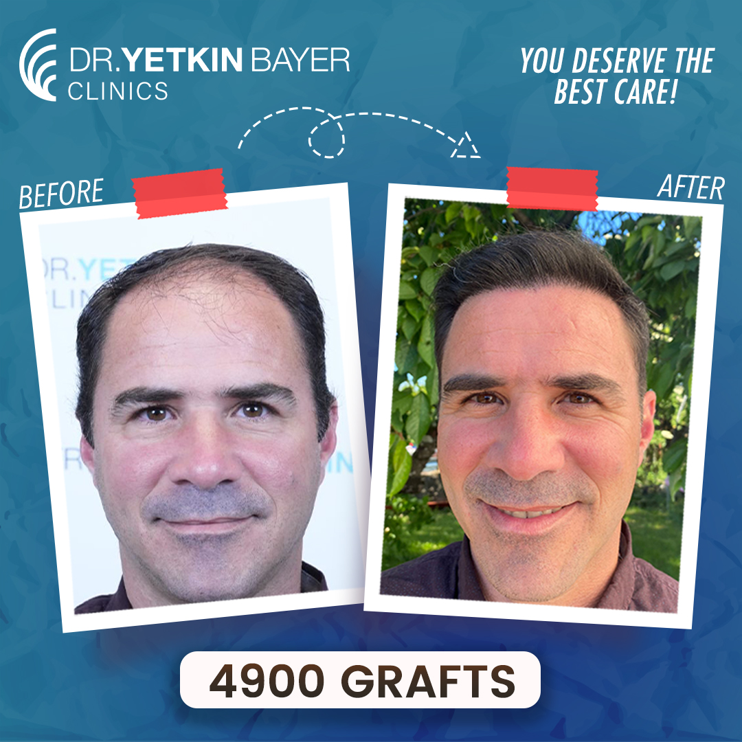 cedric_lavy_4900_grafts