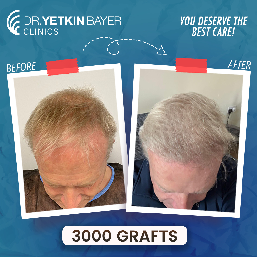 colin_lennox_3000_grafts