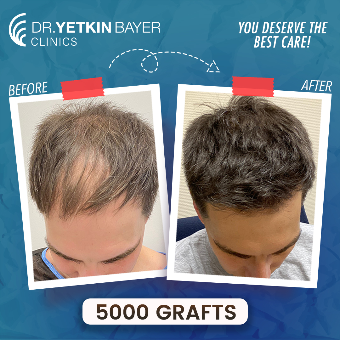 karsalov_kiril_5000_grafts