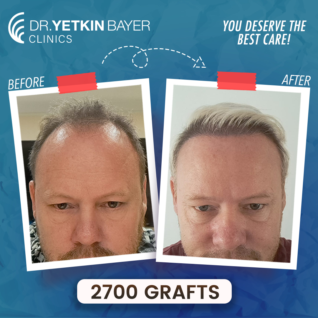 lee_read_2700_grafts