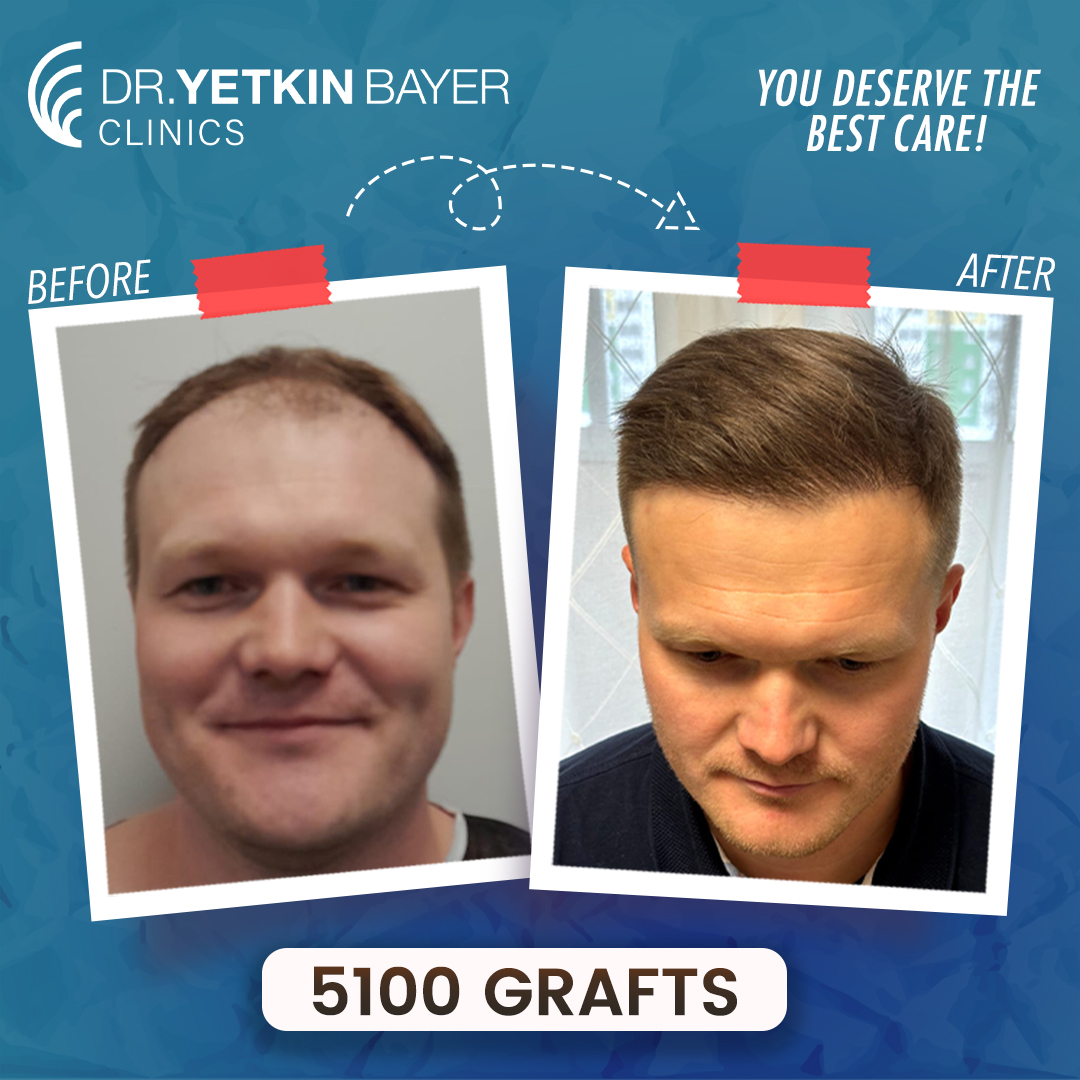 roman_kardakov_5100_grafts